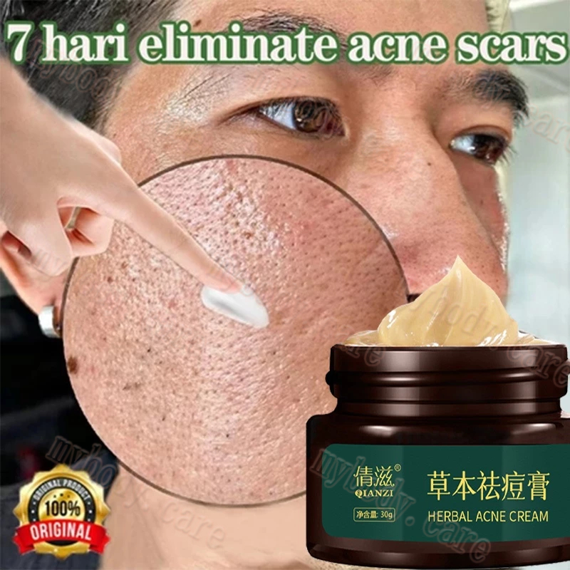 Essensi Herbal Anti Jerawat 30g -  Obat Lubang Jerawat Penghilang Bopeng Kusam Perawatan Jerawat Par