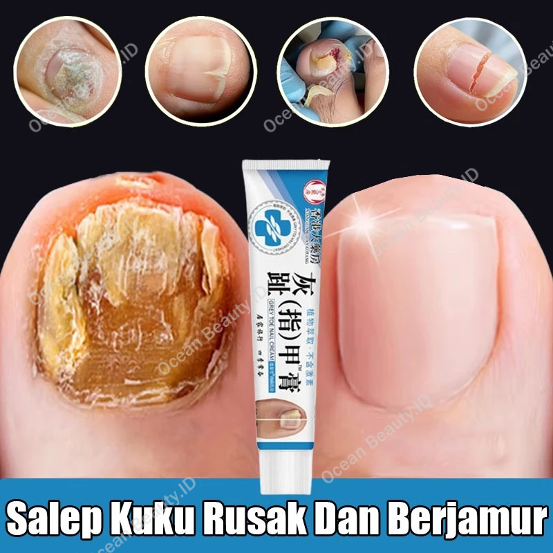 Obat Jamur Kuku Obat Cantengan Salep Kuku Rusak Dan Berjamur Pembersih Kuku Kaki Hitam Obat Kuku Ber