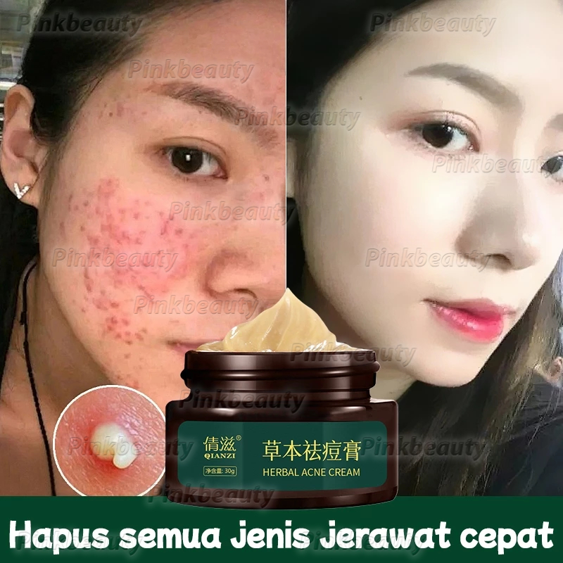 Ampuh Cream Penghilang Jerawat Herbal 30g Penghilang Bekas Jerawat Bopeng Obat Totol Jerawat Pria da
