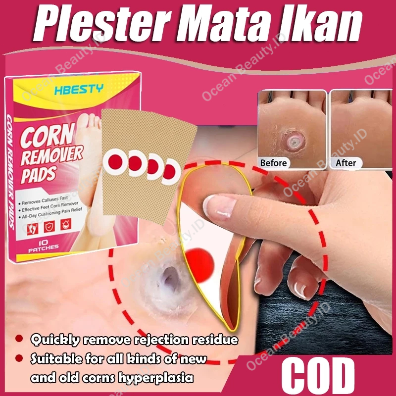 Plester Mata Ikan Plester Kutil Penghilang Kutil Ampuh Plester Mata Ikan dan Kutil Foot Corn Removal