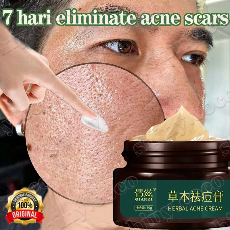 Krim Penghilang Bekas Jerawat Penghilang Jerawat Herbal Obat Lubang Jerawat Penghilang Bopeng Kusam 