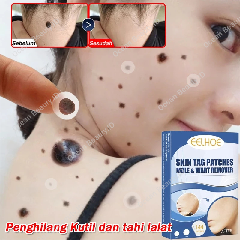 Stiker penghilang tahi lalat di wajah penghilang kutil dan tahi lalat 144 PCS plester mata ikan tela