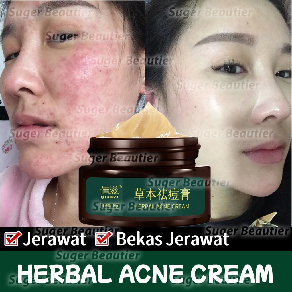 Ampuh Cream Penghilang Jerawat Herbal 30gr Penghilang Bekas Jerawat Bopeng Obat Totol Jerawat Pria d