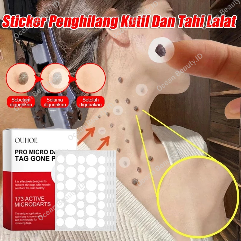 Stiker Penghilang Kutil Dan Tahi Lalat Wart Remover Patch Penghilang Kutil Di Leher Penghilang Tahi 