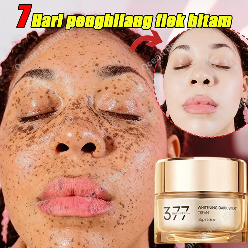 377 Cream Flek Hitam Membandel cream penghilang flek hitam di wajah membandel bpom cream pemutih waj