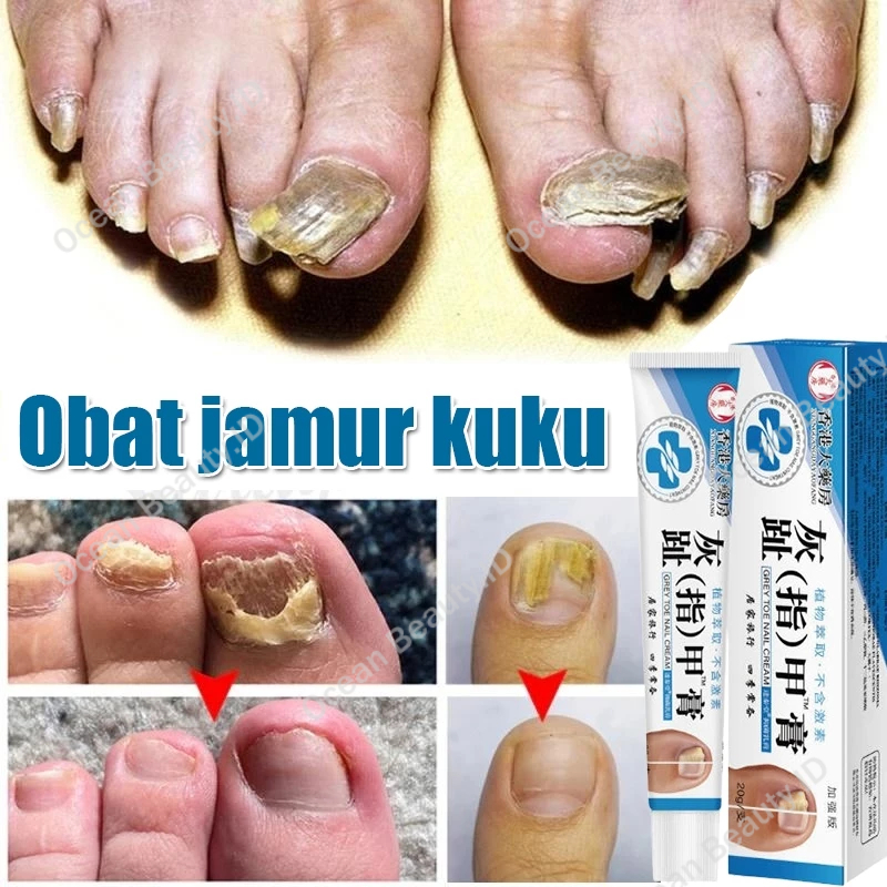 Obat Jamur Kuku Obat Cantengan Salep Kuku Rusak Dan Berjamur Pembersih Kuku Kaki Hitam Obat Kuku Ber