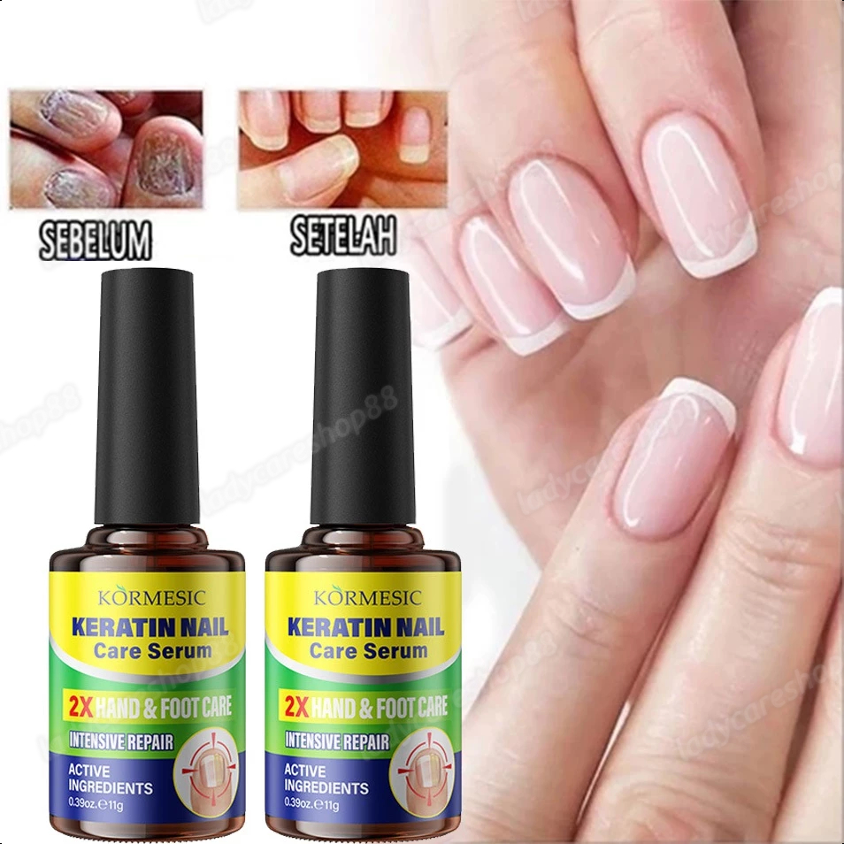 Essence perawatan kuku Obat 11g kuku jamur dan rusak Nail Repair Essence Serum Memperbaiki Kuku Rusa