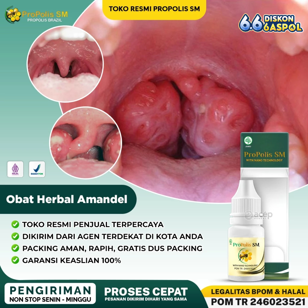 Obat Amandel, Obat Radang Tenggorokan Dewasa, Obat Sakit Tenggorokan, Obat Amandel Anak, Obat Batuk 