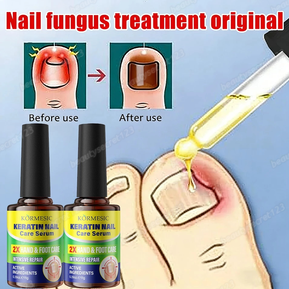 Essence perawatan kuku Obat kuku jamur dan rusak Nail Repair Essence Serum Memperbaiki Kuku Rusak Pe