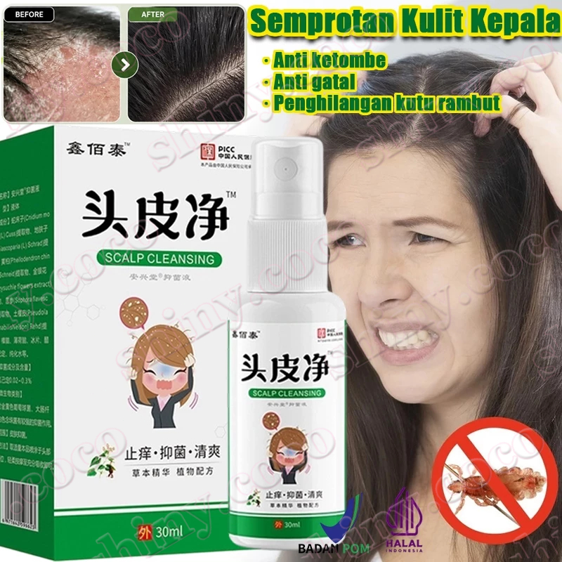 Semprotan Kulit Kepala Obat Ketombe Membandel Obat Ketombe Rambut Berkerak Kulit Kepala Gatal Ketomb