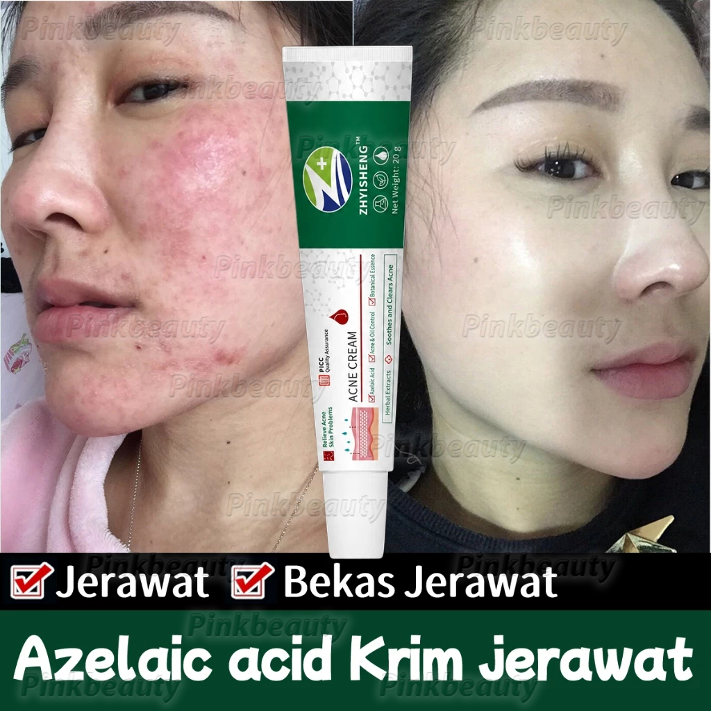 Azelaic acid Krim jerawat 20g Herbal Acne Cream Obat Totol Jerawat Obat Totol Anti Jerawat Penghilan
