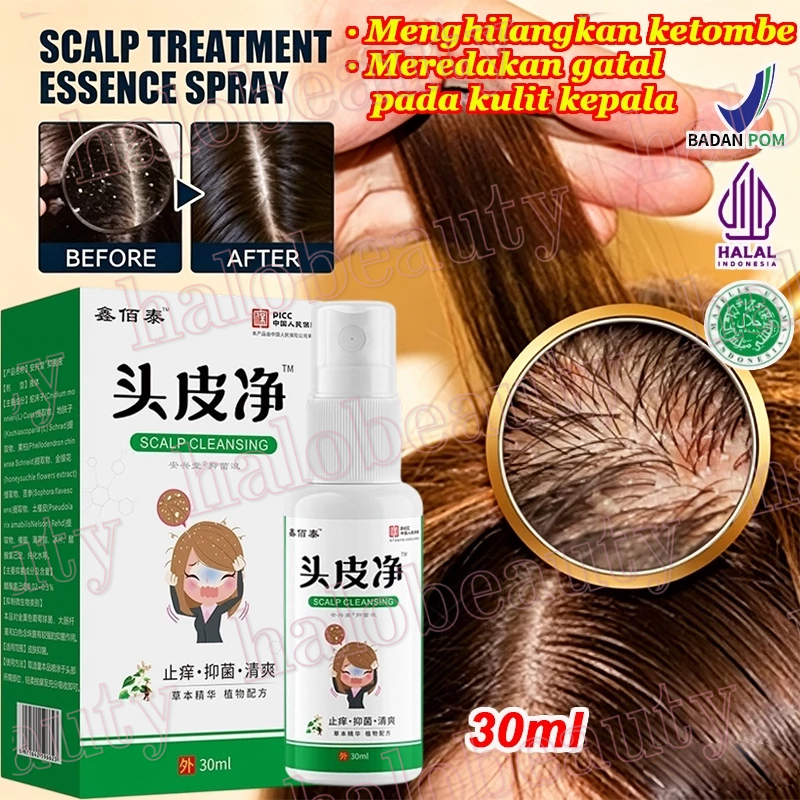 Semprotan Anti Ketombe Obat Ketombe Membandel Semprotan Kulit Kepala Serum Ketombe & Kulit Kepala Ga