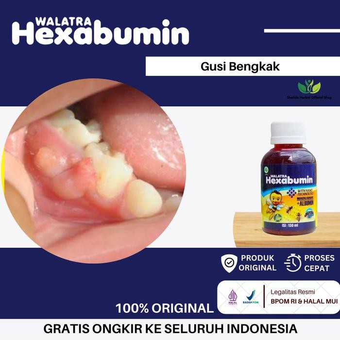 Hexabumin Solusi Tepat Gusi Bengkak Anak, Sakit Gusi Bengkak, Radang Gusi, Benjolan Di Gusi, Vitamin