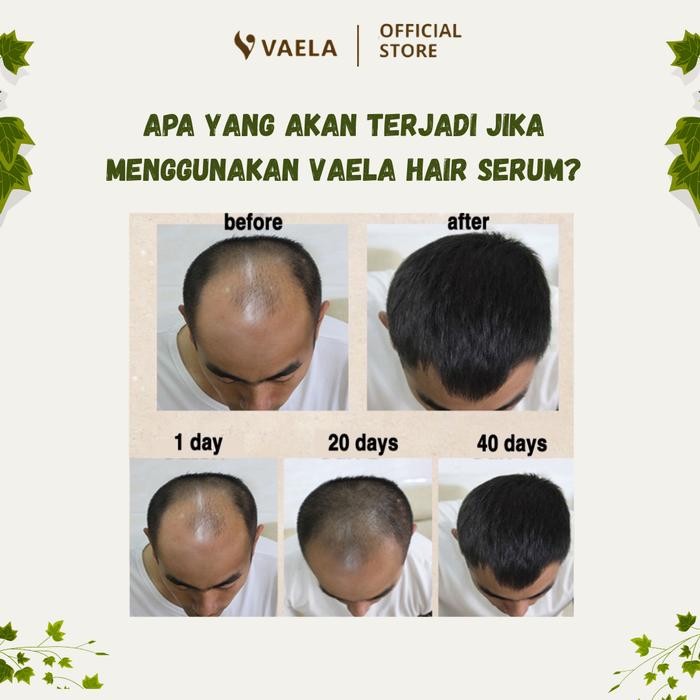 VAELA Hair Serum Serum Perawatan Rambut Rontok, Rusak & Botak Penyubur Rambut Pria & Wanita