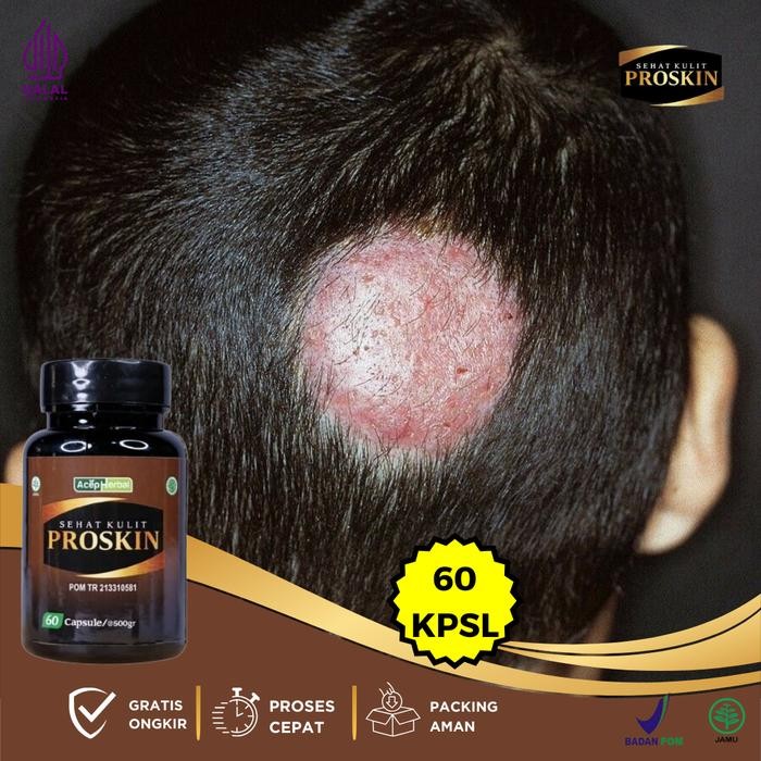 Tinea Capitis Di Kulit Kepala, Infeksi Jamur Di Kulit Kepala, Ketombe Gatal Di Kulit Kepala, Kulit