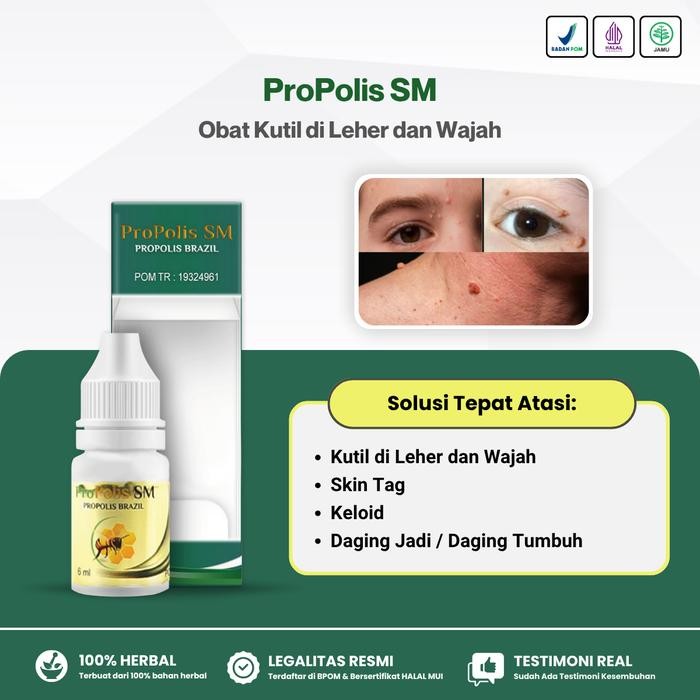 Obat Kutil Leher dan Wajah - Obat Perontok Kutil Alami Propolis SM