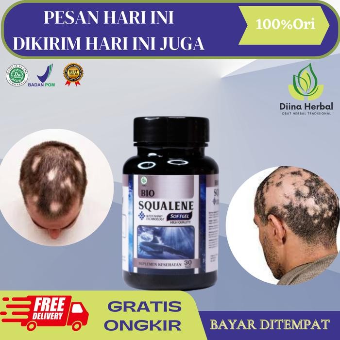 Alopecia Areata, Penumbuh Rambut Pitak, Rambut Botak Pria, Vitamin Rambut, Rambut Pitak Koin, Rambut