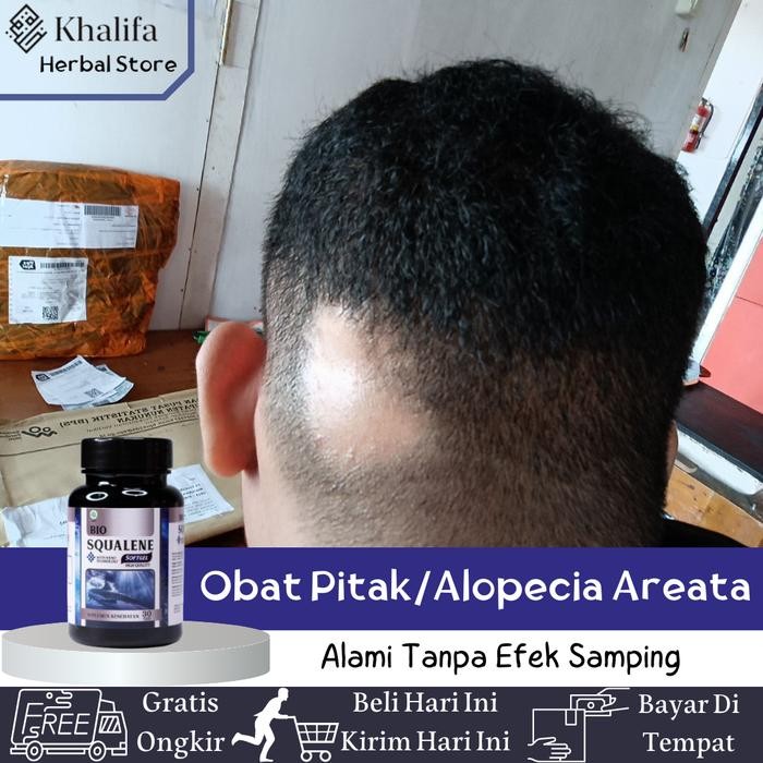 Obat Pitak ( Alopecia Areata ) Rambut Rontok Botak Koin pitak