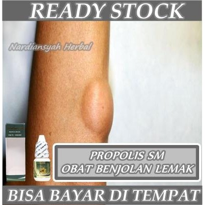 

Pilihan- Obat Penghancur Benjolan Anak & Dewasa - Penghilang Lipoma, Tiroid