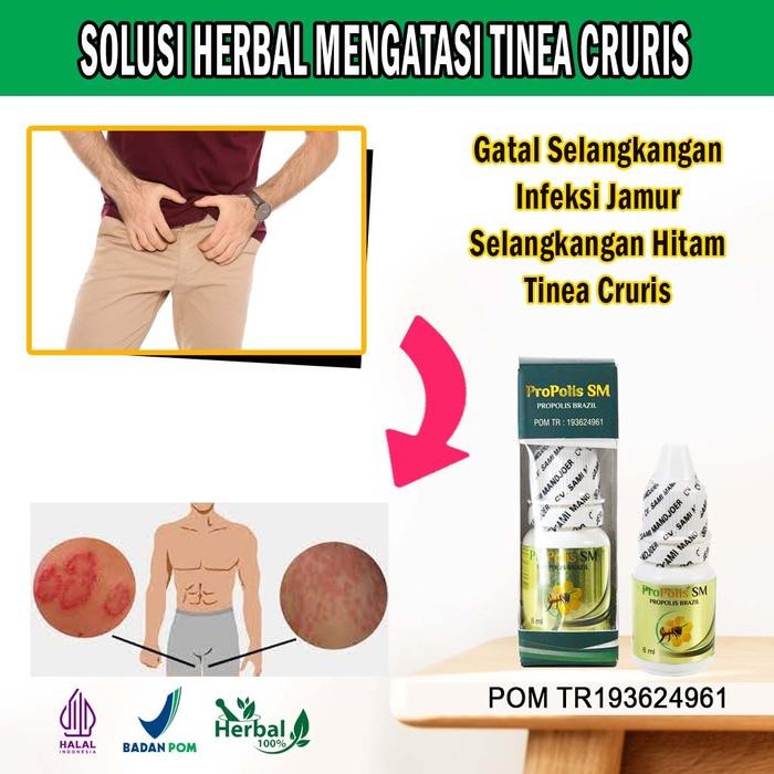 Obat Gatal Selangkangan, Infeksi Jamur Selangkangan Hitam Tinea Cruris