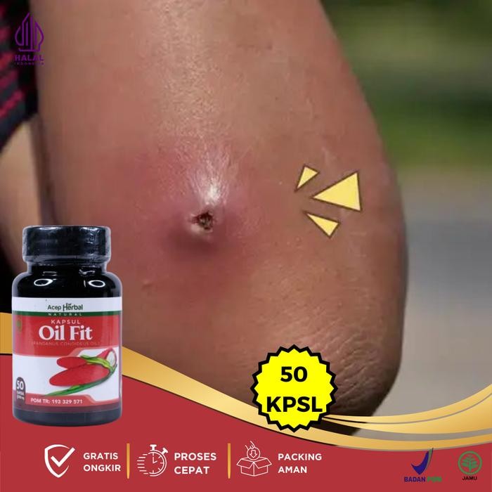 Bisulan Dipantat, Bisul Bernanah, Bisul Gak Tumbuh Lagi, Bisul Di Kemaluan, Penghilang Bisul, Bisul