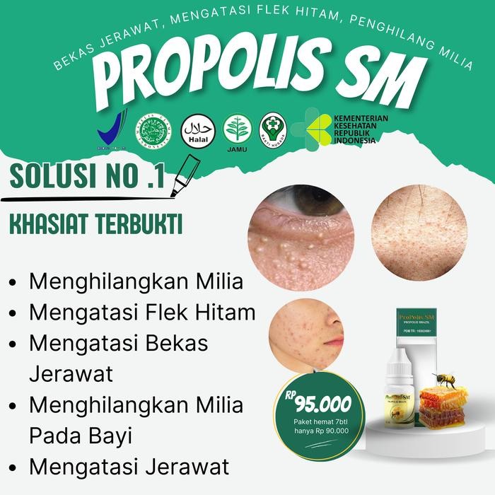 Propolis sm Milia, Milia, Penghilang Milia Dengan Cepat Propolis sm