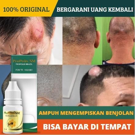 Pengempis Penghilang Benjolan di Jidat / Kening, Tumor Di Kepala, Lipoma Di Kepala, Penghancur