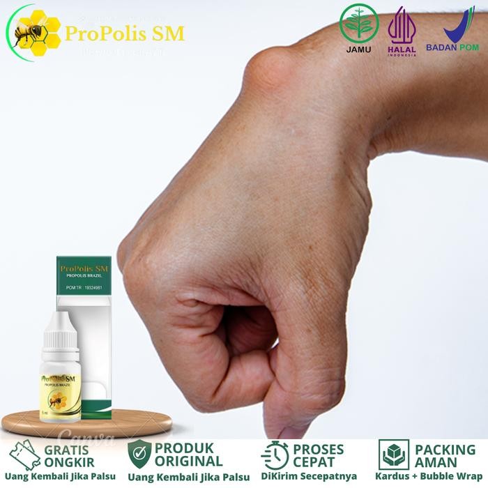 Propolis SM - Penghilang Benjolan Tangan & Kista Ganglion