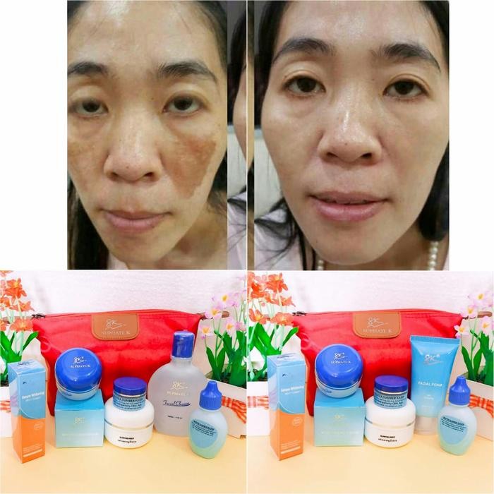M4R7 Paket Flek Hitam Skincare Dr Supijati