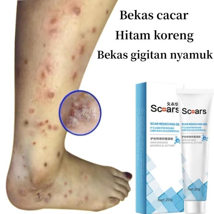 PENGHILANG BEKAS LUKA LAMA MENGHITAM SALEP KORENG BUDUKAN PALING AMPUH ANAK DEWASA BEKAS GIGIT