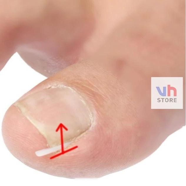 Bantalan Silikon Kuku Ingrown Nail Isolation Pad Mencegah Cantengan *