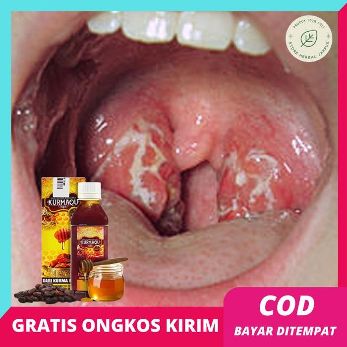 

Pilihan- Madu Khusus Amandel Herbal Untuk Anak Dan Dewasa - Penghancur Amandel - Pengempes