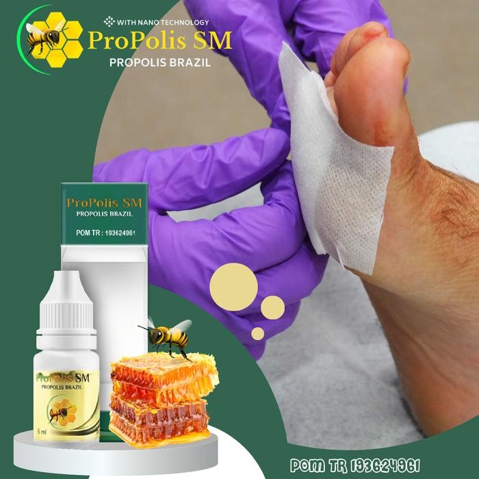 Luka Diabetes Kering/Basah/Luka Diabetes Bernanah/Pengering Luka Diabetes - Propolis SM