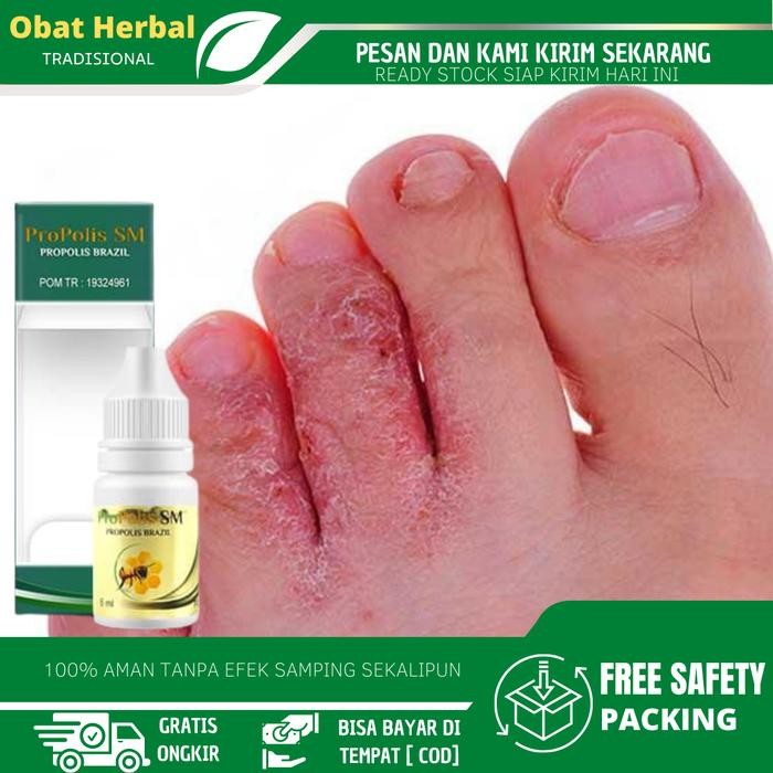Propolis SM Salep Kutu Air Pada Kaki, Jamur Kutu Air, Kutu Air Pada Sela Jari kaki, Penghilang Kuman