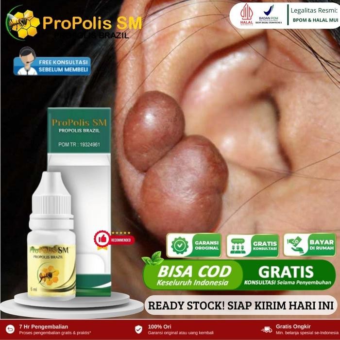 Penghilang Keloid di Telinga, Penghilang Keloid, Keloid Menonjol, Luka Keloid, Keloid Menahun,