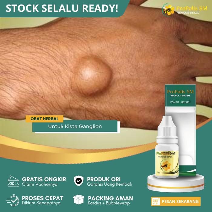 Obat Kista Ganglion Benjolan Di Pergelangan Tangan Mengecilkan Kista Ganglion Penghilang Benjolan