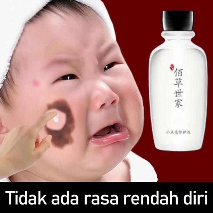 Penghilang Tanda Lahir Di Wajah Obat Penghilang Tanda Lahir Coklat Memudarkan Tanda Lahir Salep