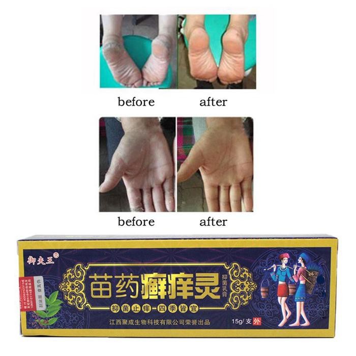 Miao Yao Krim Salep Cina untuk Mengobati Psoriasis / Dermatitis