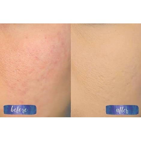 (Share Jar) La Roche Posay Effaclar Bb Blur 5Ml Kode 1022