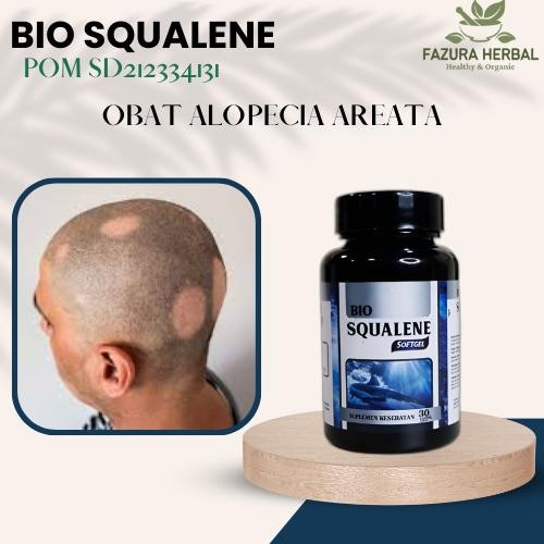 Obat Mengatasi Alopecia Areata, Obat Rambut Pitak Obat Penumbuh Rambut
