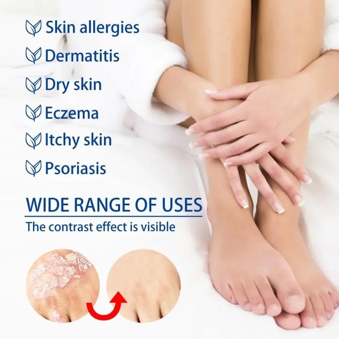 Promo Salep Khusus Psoriasis Ointment - Import - Kurap Pada Kulit Kepala - Kutu Air - Kurap Pada