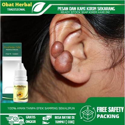 Penghilang Keloid Menonjol Di Telinga, Keloid Luka Tindik, Benjolan di Daun Telinga, Daging Tumbuh