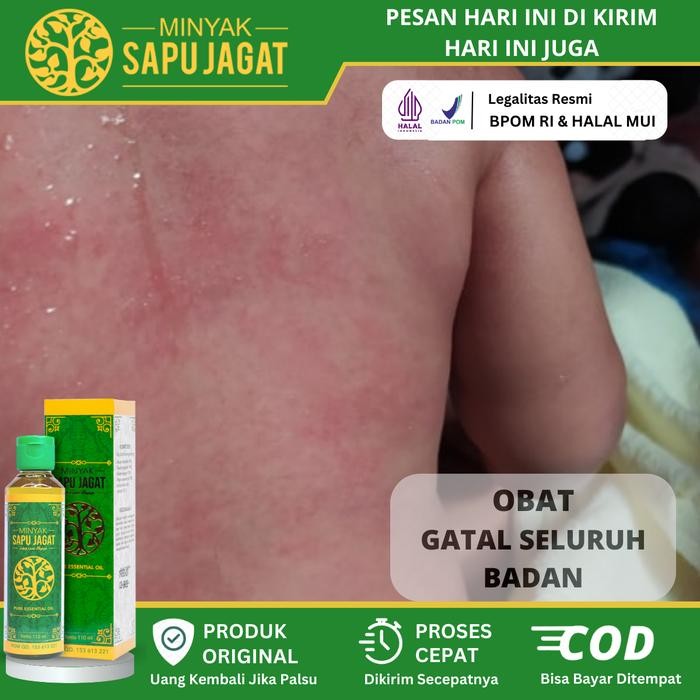 Minyak Oles Gatal-Gatal Di Seluruh Badan, Alergi, Gangguan Kulit, Gatal-Gatal Pada Bagian Kaki