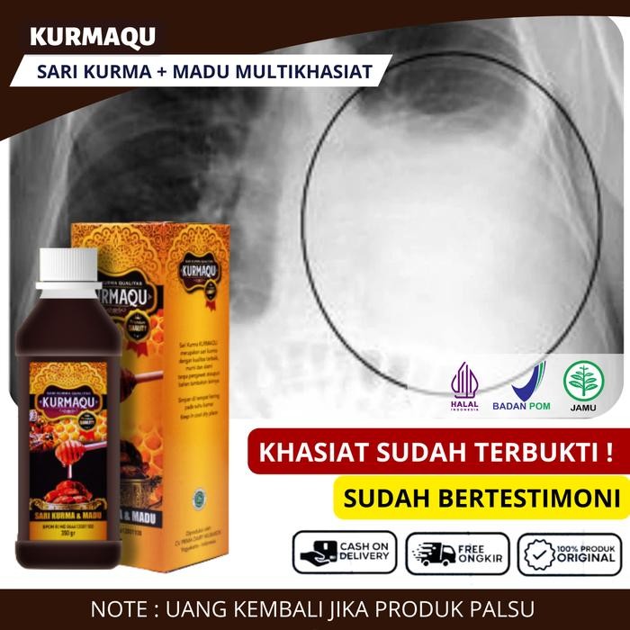 

Pilihan- Kurmaqu Sari Kurma Dan Madu Untuk Paru-Paru Basah, Tbc Paru Dan Batuk Menahun,