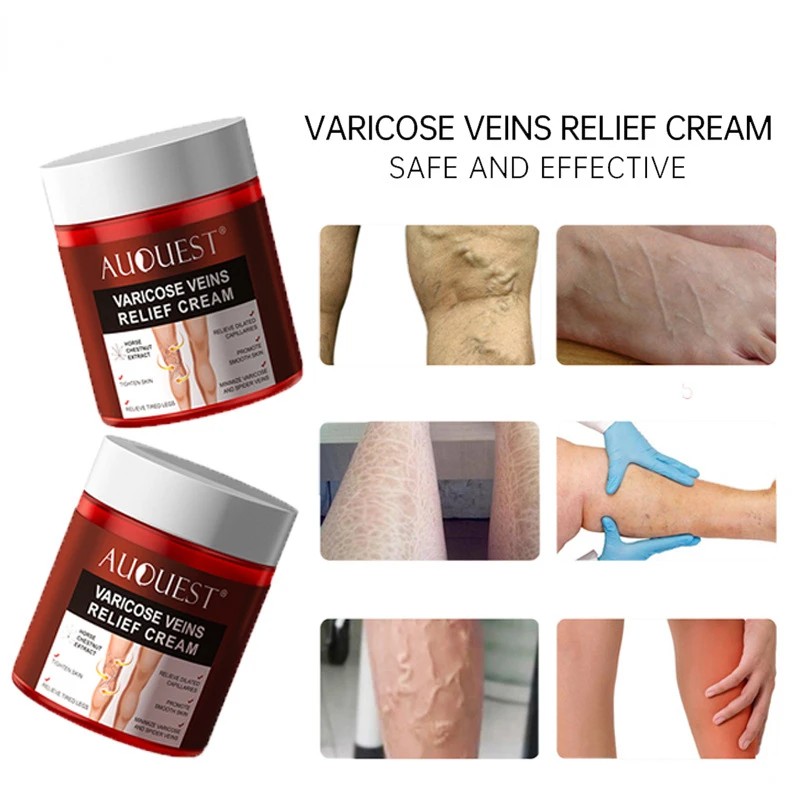 Feet Varicose Veins Cream Treatment Relieve Dilated Capillaries Remove Phlebitis Spider Leg Vein