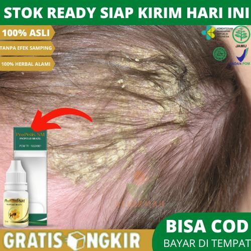 Diskon Propolis Sm Brazil Untuk Kulit Kepala Berkerak, Psoriasis, Dermatitis Seboroik Kulit Kepala