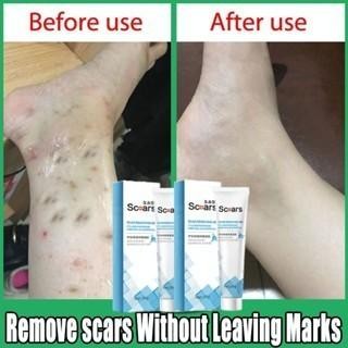 SALEP PENGHILANG BEKAS LUKA LAMA MENGHITAM KORENG BUDUKAN PALING AMPUH ANAK DEWASA BEKAS GIGIT