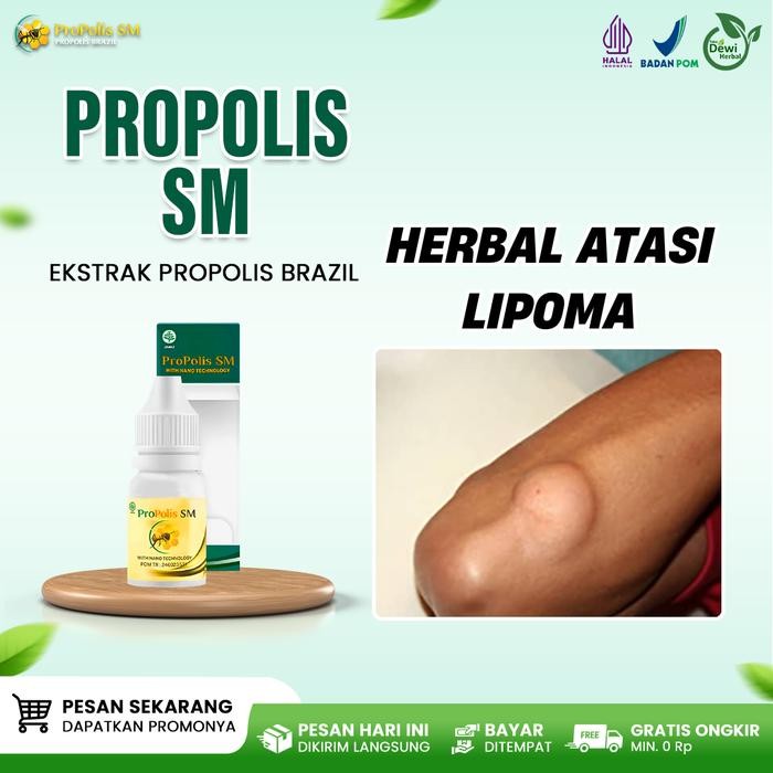 Propolis SM Herbal Untuk Lipoma Di Punggung, Benjolan Lemak Lipoma Pecah, Tumor Jinak Pada Anak &