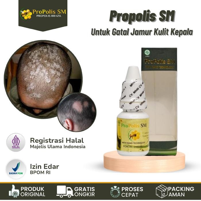 Cairan Oles Jamur Kulit Kepala, Kurap Kepala, Psoriasis Kepala, Tinea Capitis, Ketombe Berkerak