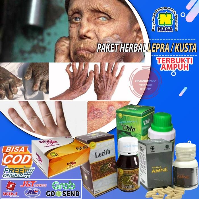 New Obat Herbal Lepra / Kusta Nasa Obat Infeksi Kulit Kusta / Lepra Teruji High Quality